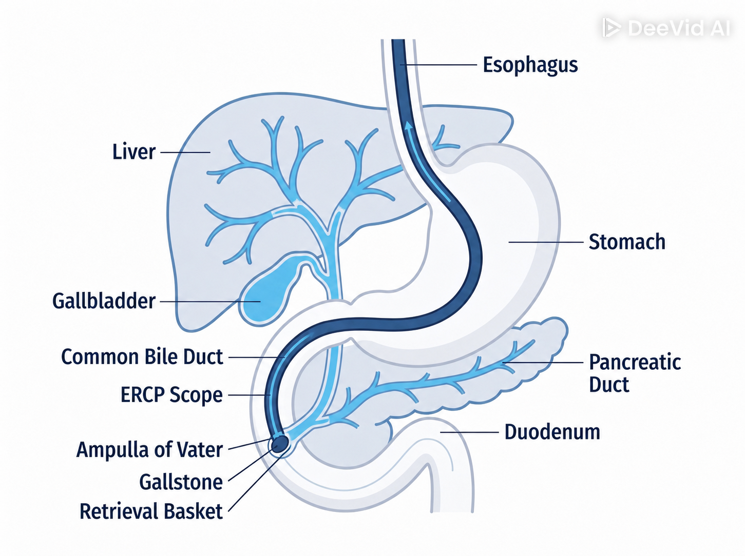 ERCP